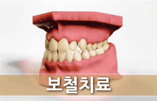 보철치료